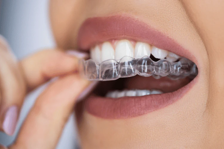 Mastering Dental Implant Planning and Placement